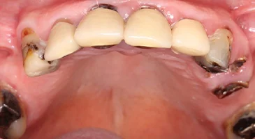 Before treatment: a badly broken-down upper arch with only a few natural teeth remaining