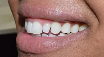Before composite bonding: a gap between the upper front teeth