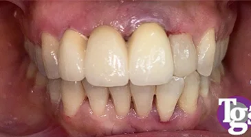 After treatment: an evenly matched, natural-coloured upper front tooth