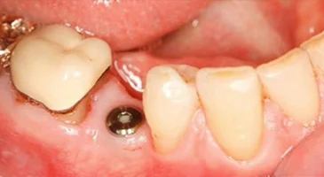 Before treatment: an implant post visible in the gap left by a missing back tooth