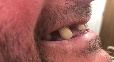 Before treatment: only a few natural teeth remaining, with gaps along the arch