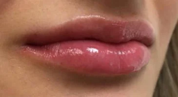 After dermal filler: fuller, more defined lips