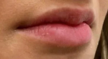 Before dermal filler: thinner lips