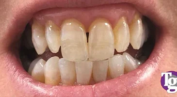 After teeth whitening: lighter upper and lower front teeth