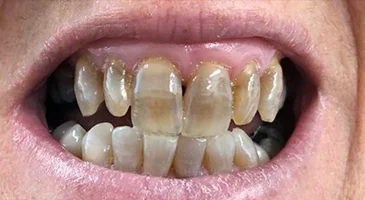 Before teeth whitening: heavily stained upper and lower front teeth