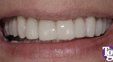 After porcelain veneers: rebuilt, uniform upper front teeth